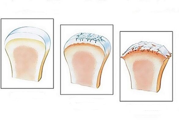 joint damage at different stages of development of arthrosis