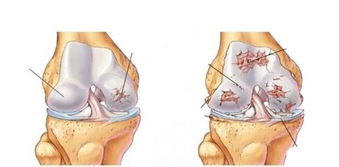 deforming arthrosis of the knee