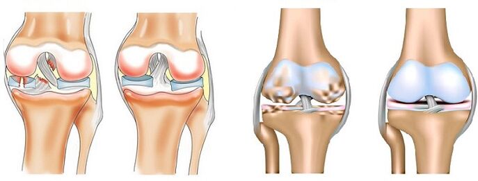Difference between arthritis (left) and osteoarthritis (right) of the joints