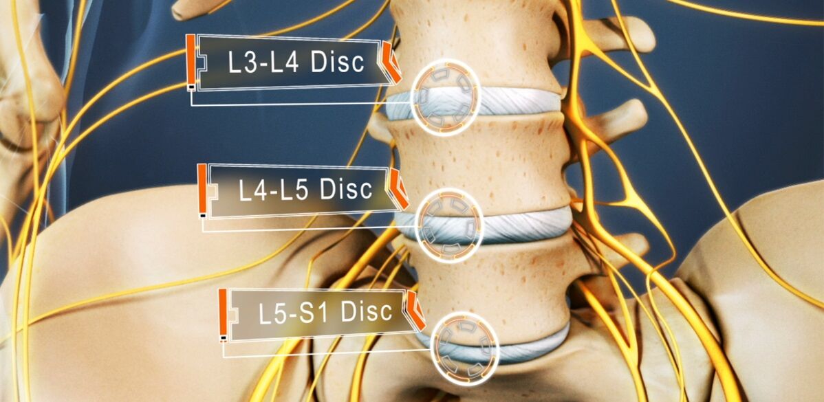Lumbar spine discs, which are most often affected in osteochondrosis