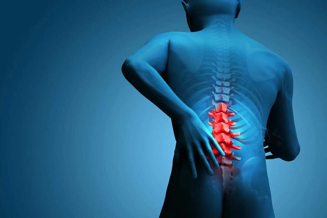 The main symptom of osteochondrosis of the lumbar spine is low back pain. 