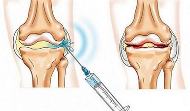 Knee joint block for arthrosis