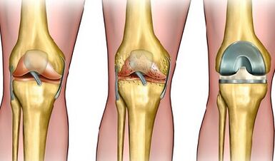 The degree of development of knee articulation arthrosis