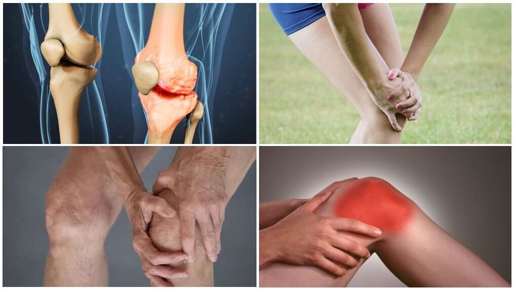 Arthrosis stages