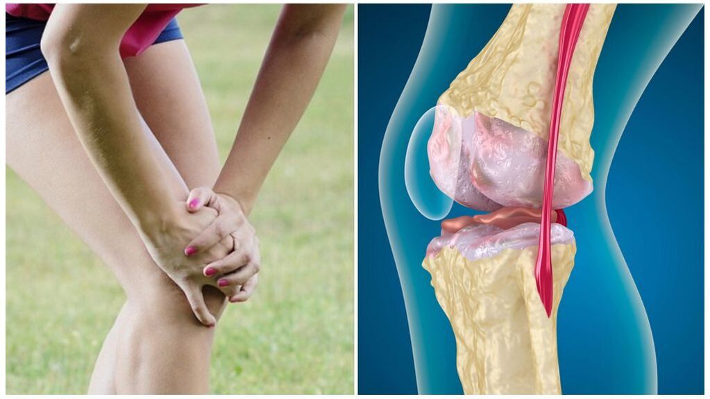 Arthrosis symptoms