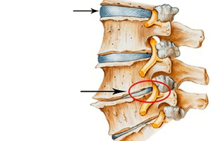 Normal and damaged column with cervical osteochondrosis