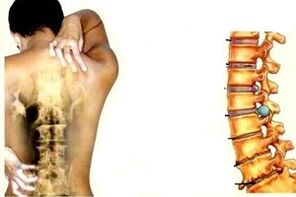 back pain at different stages of cervical osteochondrosis development