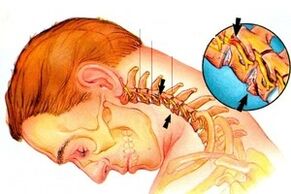 pinching the nerve in the spine with cervical osteochondrosis