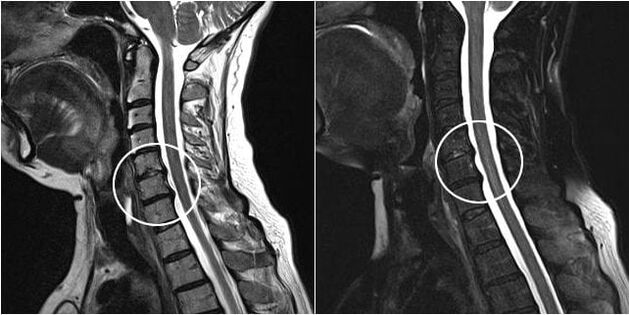 magnetic resonance imaging of the cervical spine