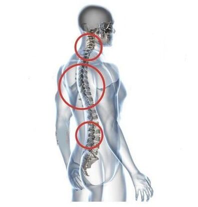 spinal osteochondrosis sites